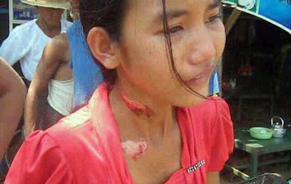 Aye Yu Aung of Kyaukgyi Township was badly burnt by her employer. (Photo: Facebook)
